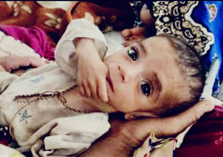 .یونیسف: نزدیک به 900 هزار کودک افغان در 2023 از لاغری و سو تغذیه رنج می برند