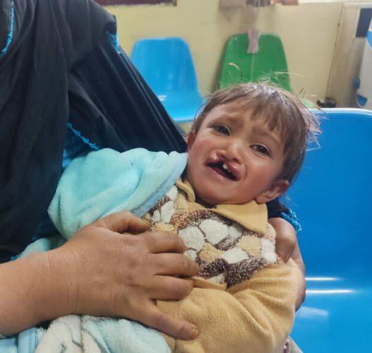۱۰۰ کودک مبتلا به بیماری «لب‌چاک و کام‌چاک» در کابل رایگان درمان میشوند !